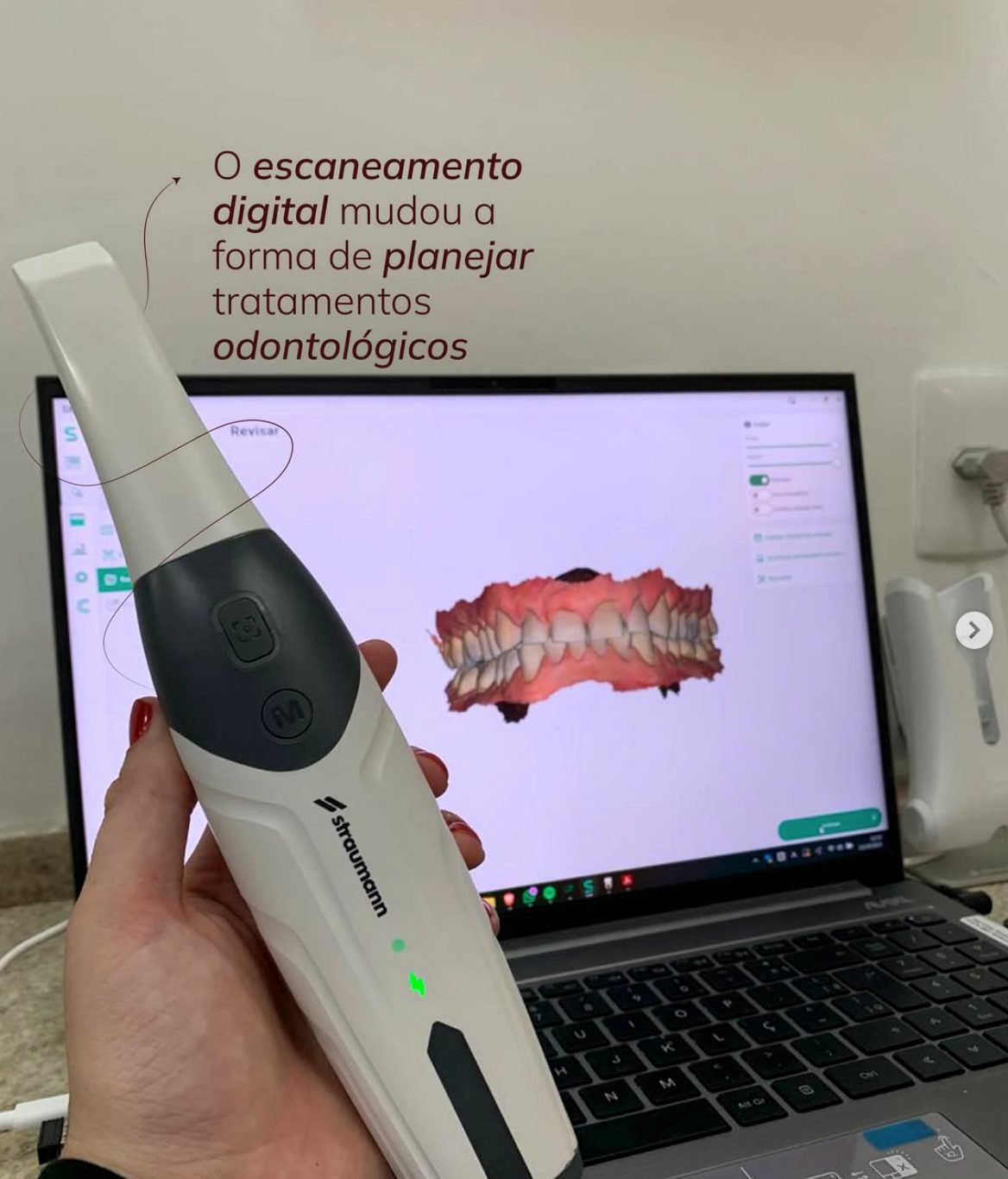 Scanner intraoral e planejamento digital odontológico em tela
